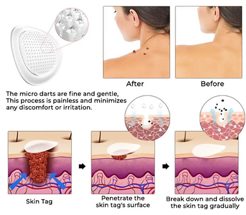 ✨ KUBOZN® MicroDarts Skin Tag Patch – Fun Shapes Edition for Gentle Care (offer)