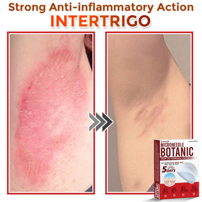 Cvreoz® MicroNeedle Botanic Skin Tag Removal Patch 🇺🇸 Made in the USA