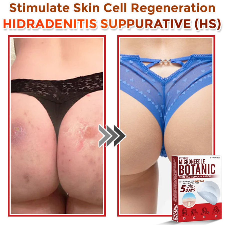 Cvreoz® MicroNeedle Botanic Skin Tag Removal Patch 🇺🇸 Made in the USA