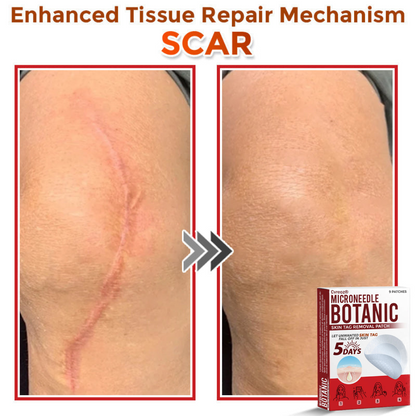 Cvreoz® MicroNeedle Botanic Skin Tag Removal Patch 🇺🇸 Made in the USA