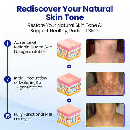 Cvreoz® Vitiligo Treatment Spray