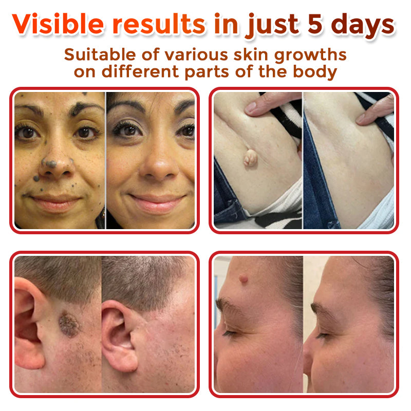 Cvreoz® MicroNeedle Botanic Skin Tag Removal Patch 🇺🇸 Made in the USA